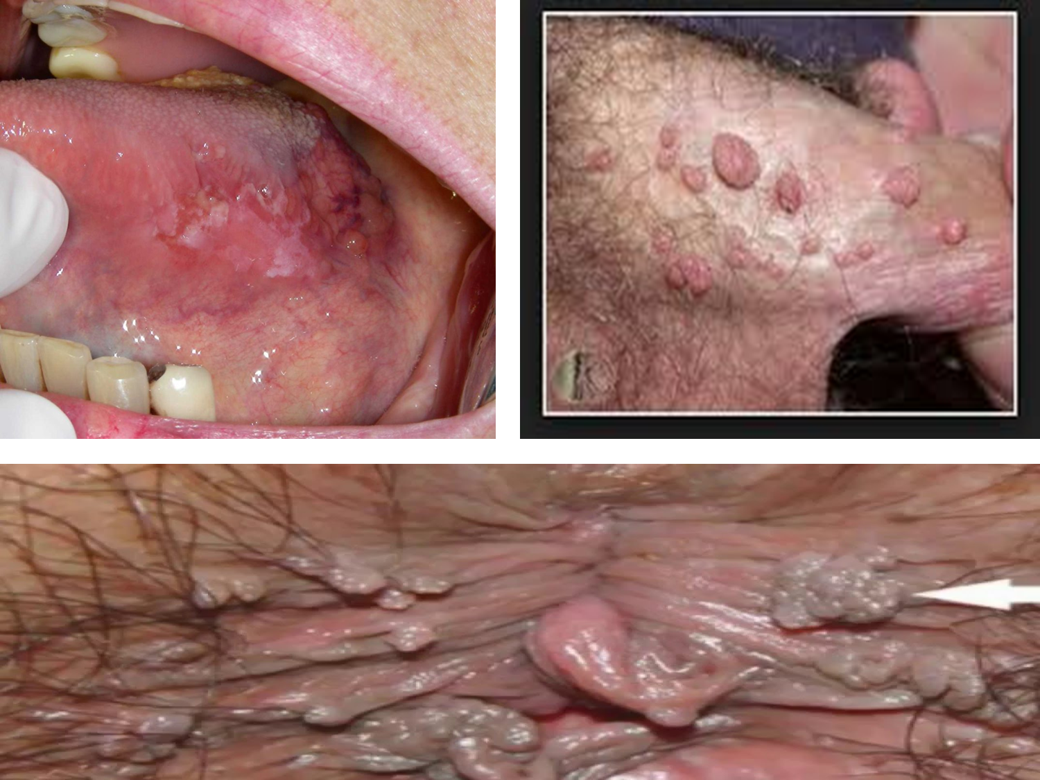 Virus vph fotos